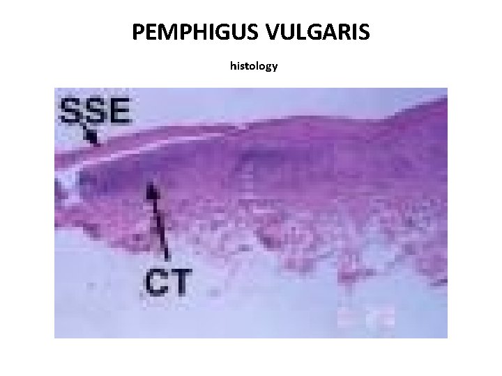 PEMPHIGUS VULGARIS histology 
