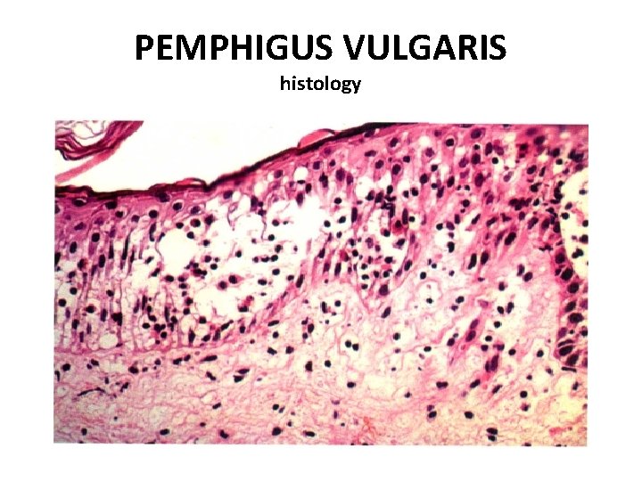 PEMPHIGUS VULGARIS histology 