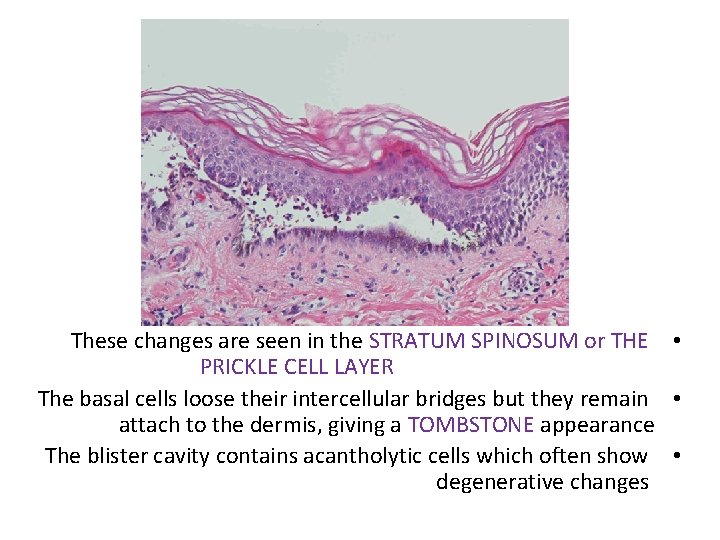 These changes are seen in the STRATUM SPINOSUM or THE • PRICKLE CELL LAYER