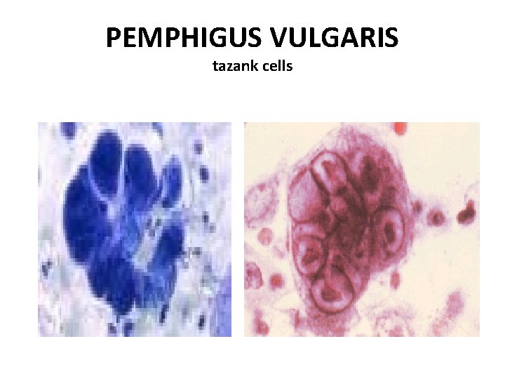 PEMPHIGUS VULGARIS tazank cells 