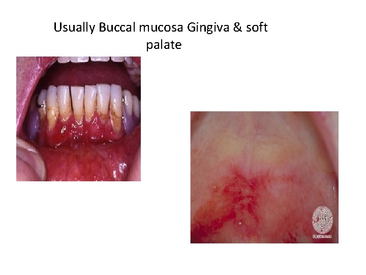 Usually Buccal mucosa Gingiva & soft palate 