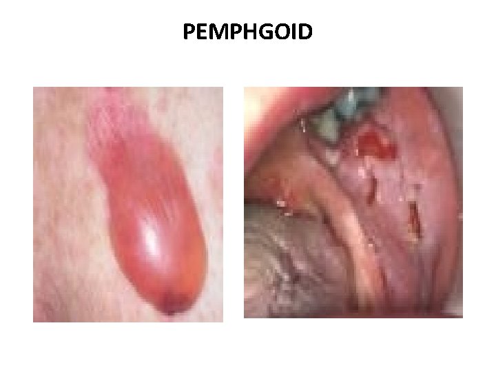 PEMPHGOID 