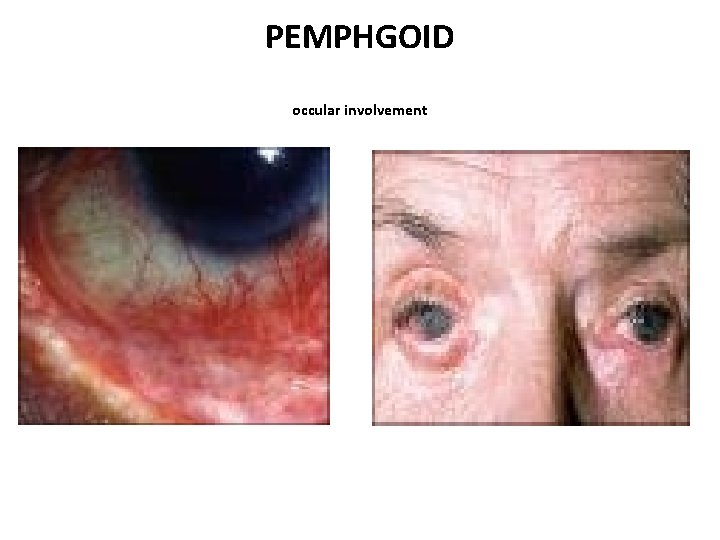 PEMPHGOID occular involvement 