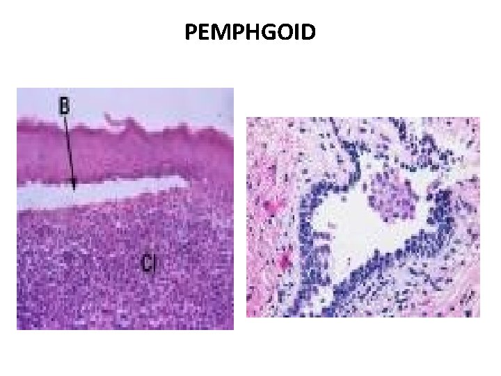 PEMPHGOID 