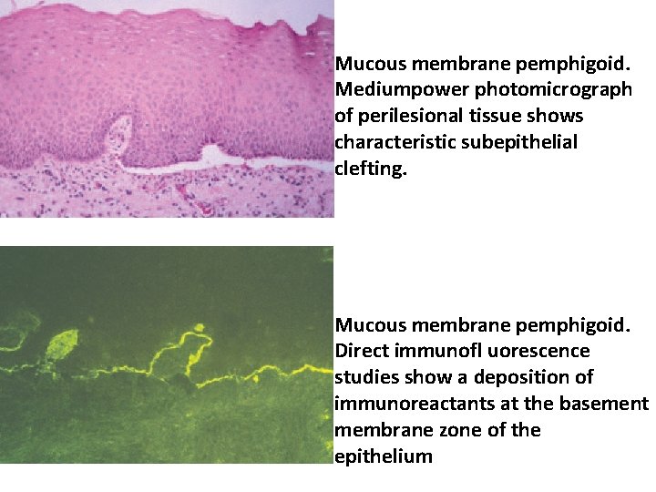 Mucous membrane pemphigoid. Mediumpower photomicrograph of perilesional tissue shows characteristic subepithelial clefting. Mucous membrane