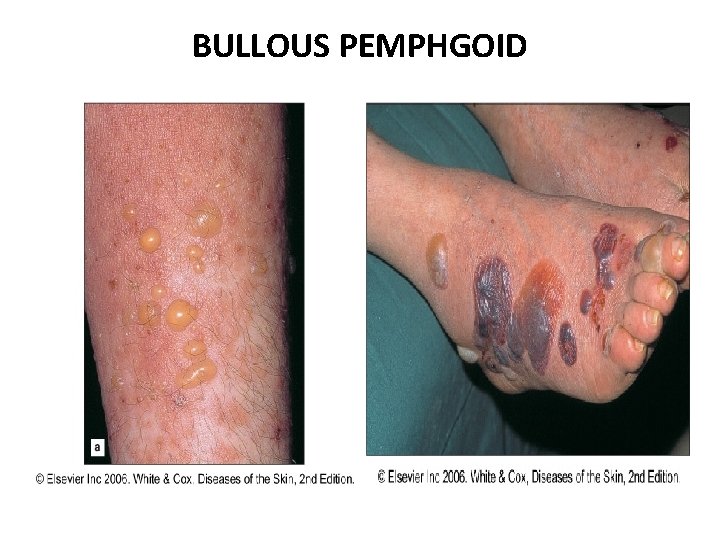 BULLOUS PEMPHGOID 