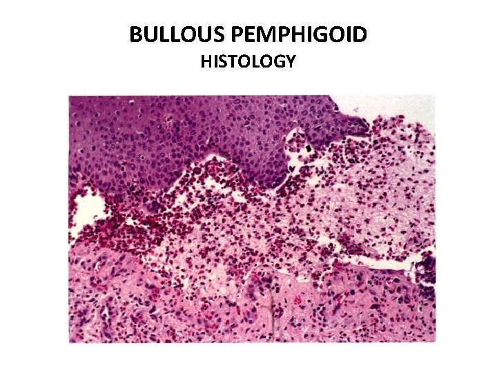BULLOUS PEMPHIGOID HISTOLOGY 