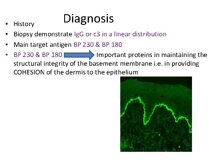  • • Diagnosis History Biopsy demonstrate Ig. G or c 3 in a