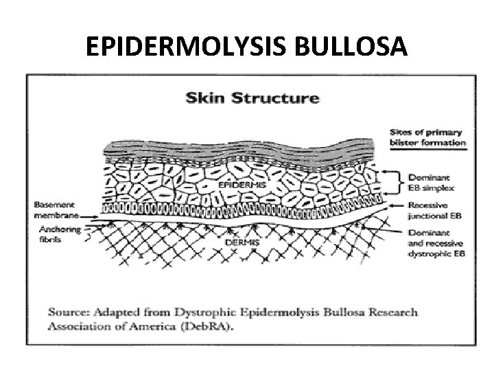 EPIDERMOLYSIS BULLOSA 