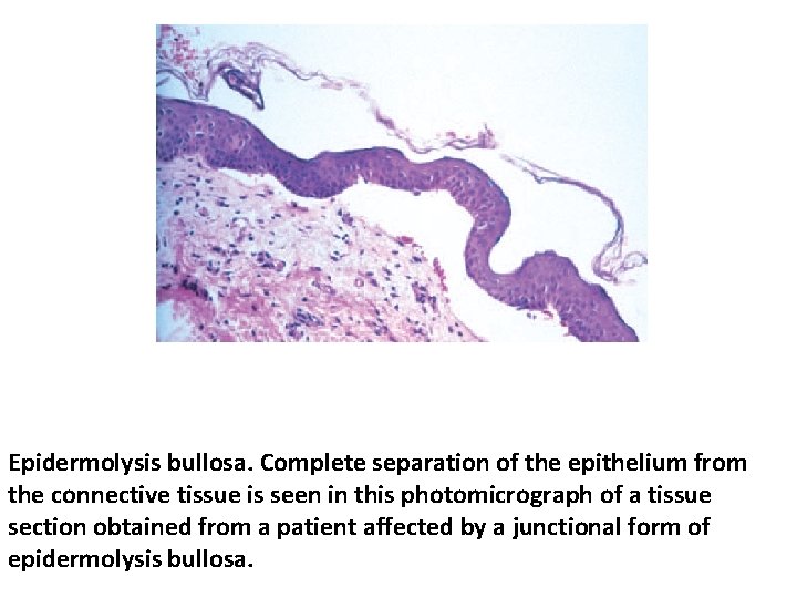 Epidermolysis bullosa. Complete separation of the epithelium from the connective tissue is seen in