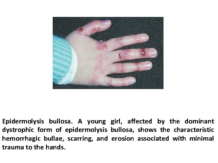 Epidermolysis bullosa. A young girl, affected by the dominant dystrophic form of epidermolysis bullosa,