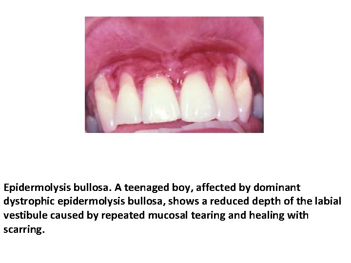 Epidermolysis bullosa. A teenaged boy, affected by dominant dystrophic epidermolysis bullosa, shows a reduced