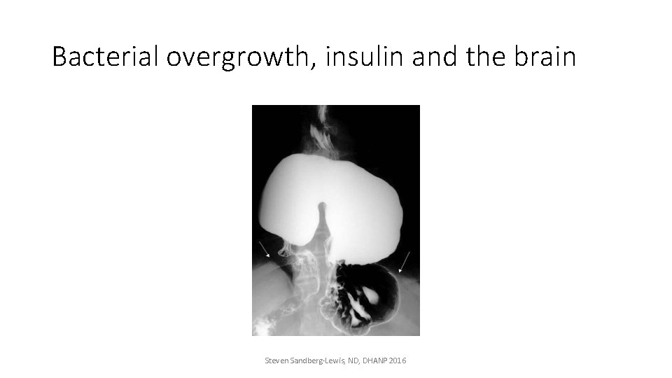 Bacterial overgrowth, insulin and the brain Steven Sandberg-Lewis, ND, DHANP 2016 