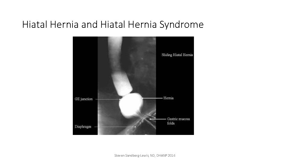 Hiatal Hernia and Hiatal Hernia Syndrome Steven Sandberg-Lewis, ND, DHANP 2016 