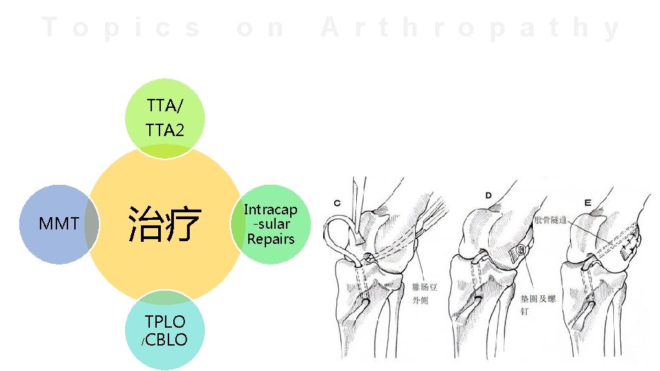 T o p i c s o n TTA/ TTA 2 MMT 治疗 TPLO