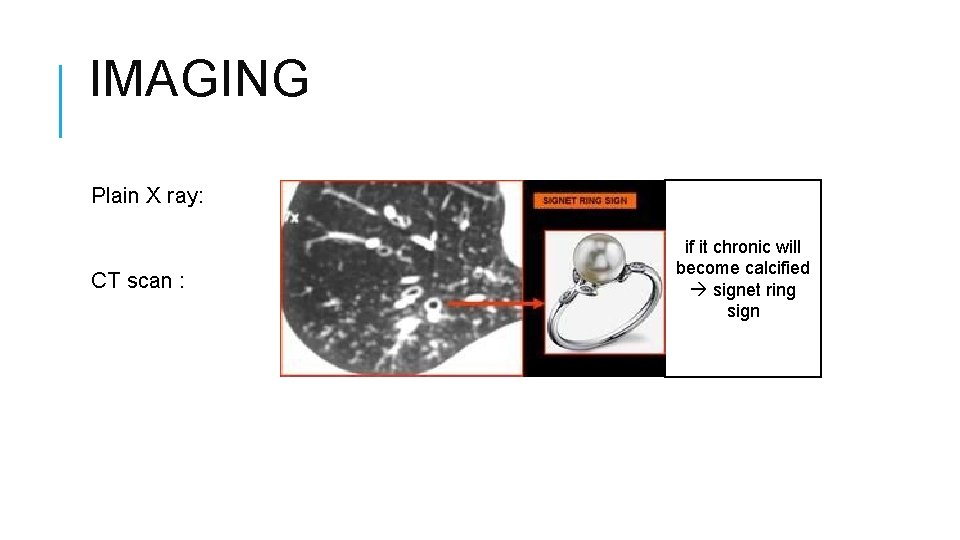 IMAGING Plain X ray: CT scan : if it chronic will become calcified signet