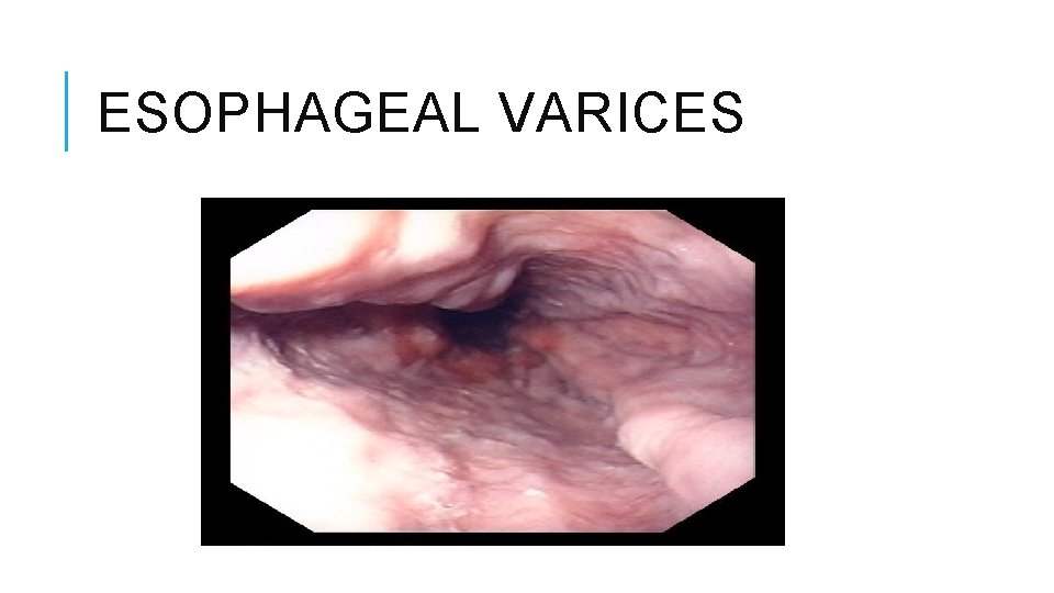 ESOPHAGEAL VARICES 