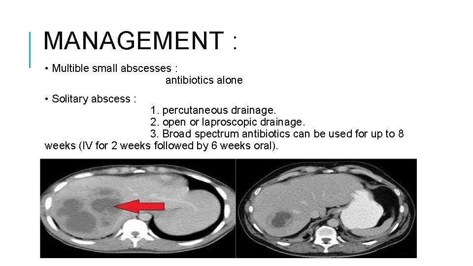 MANAGEMENT : • Multible small abscesses : antibiotics alone • Solitary abscess : 1.