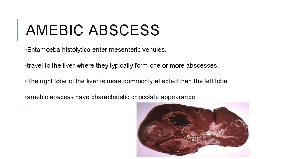 AMEBIC ABSCESS • Entamoeba histolytica enter mesenteric venules. • travel to the liver where