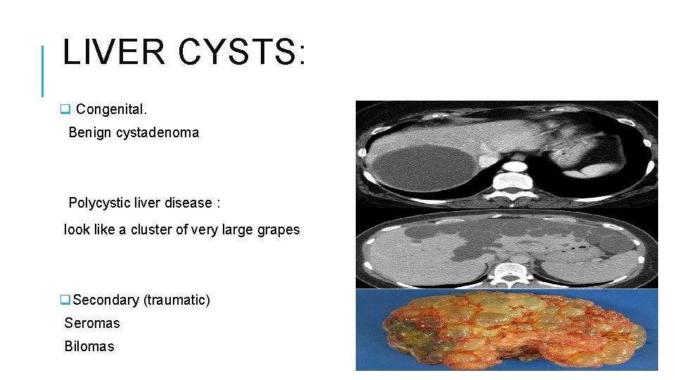 LIVER CYSTS: q Congenital. Benign cystadenoma Polycystic liver disease : look like a cluster