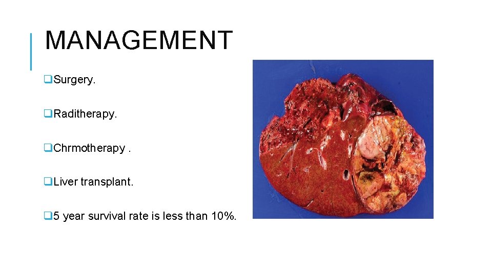 MANAGEMENT q. Surgery. q. Raditherapy. q. Chrmotherapy. q. Liver transplant. q 5 year survival