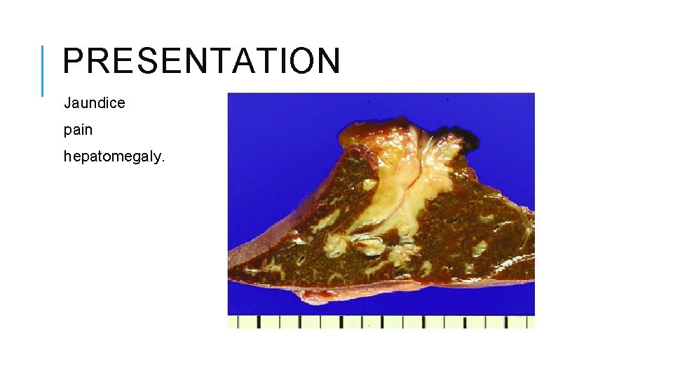PRESENTATION Jaundice pain hepatomegaly. 