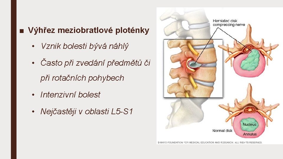 ■ Výhřez meziobratlové ploténky • Vznik bolesti bývá náhlý • Často při zvedání předmětů