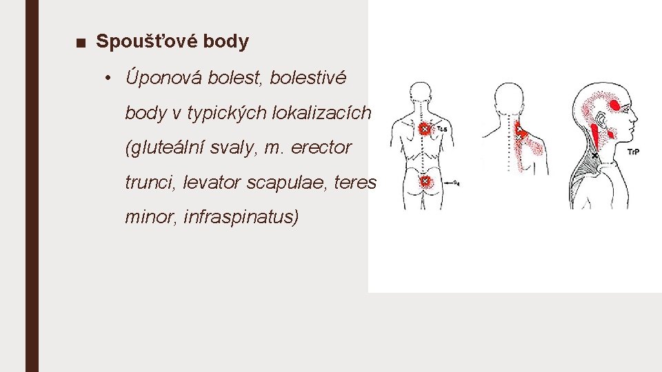 ■ Spoušťové body • Úponová bolest, bolestivé body v typických lokalizacích (gluteální svaly, m.