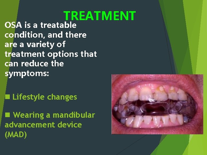 TREATMENT OSA is a treatable condition, and there a variety of treatment options that