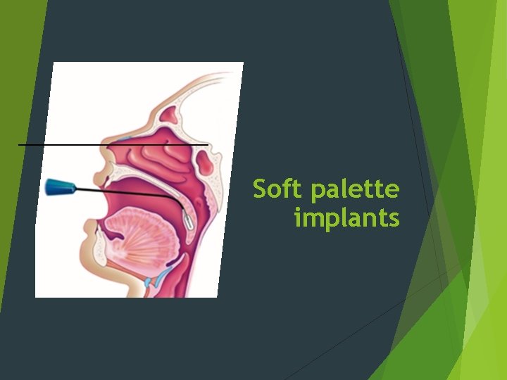 Soft palette implants 