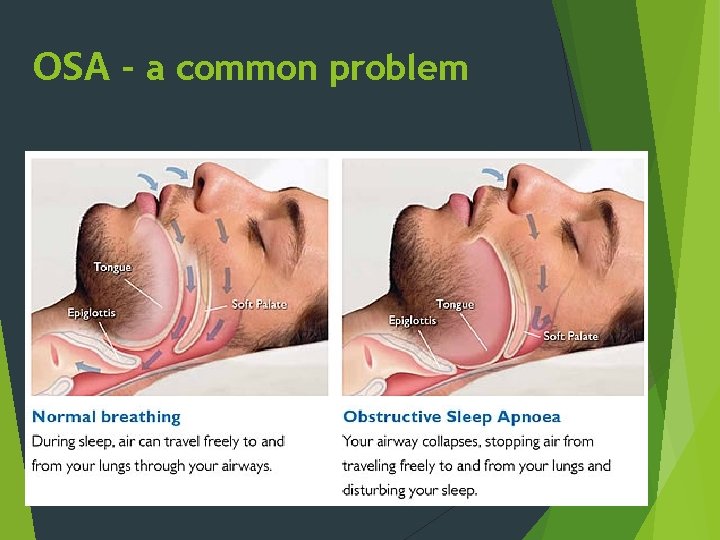 OSA – a common problem 