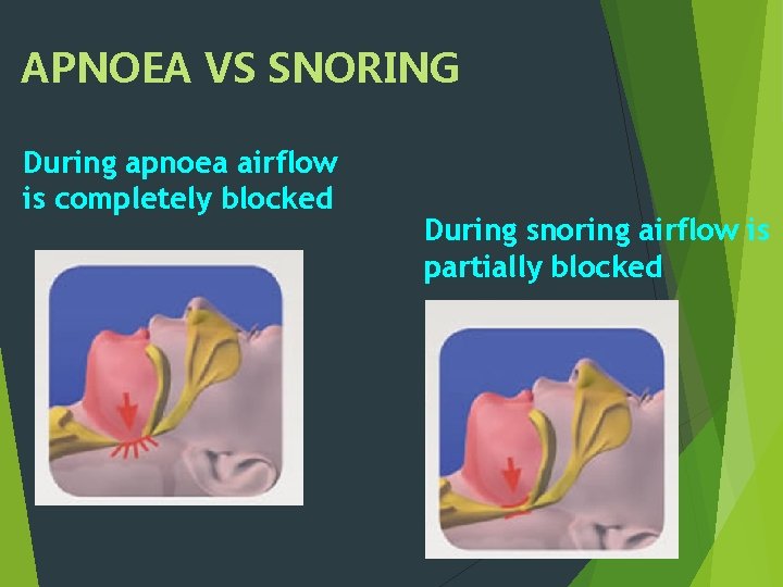 APNOEA VS SNORING During apnoea airflow is completely blocked During snoring airflow is partially