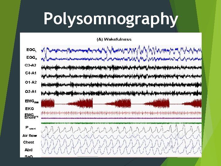 Polysomnography 