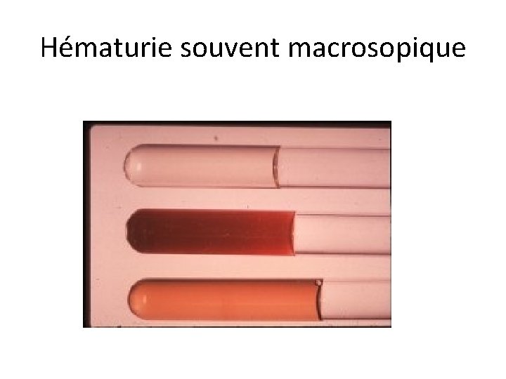 Hématurie souvent macrosopique 