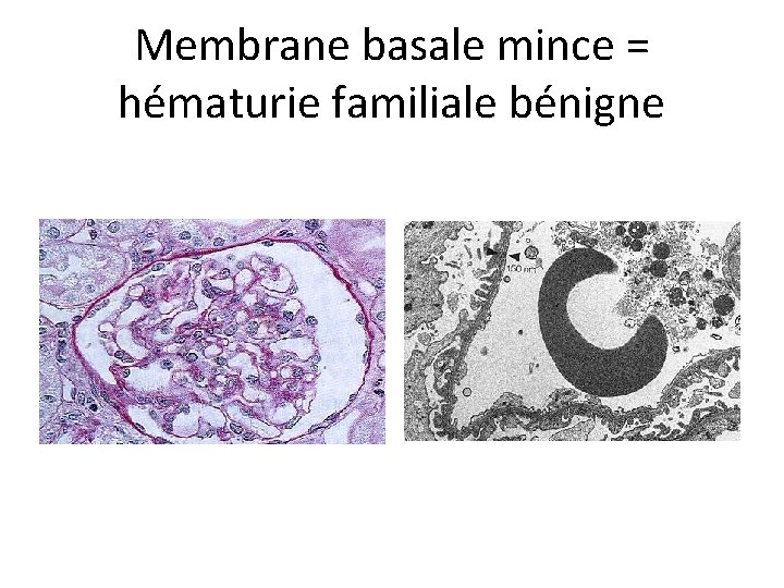Membrane basale mince = hématurie familiale bénigne 