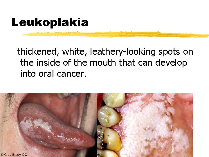 Leukoplakia thickened, white, leathery-looking spots on the inside of the mouth that can develop