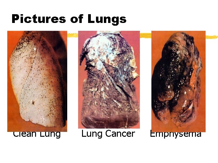 Pictures of Lungs Clean Lung Cancer Emphysema 