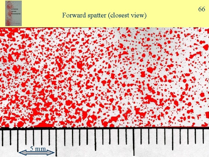 Forward spatter (closest view) 5 mm 66 