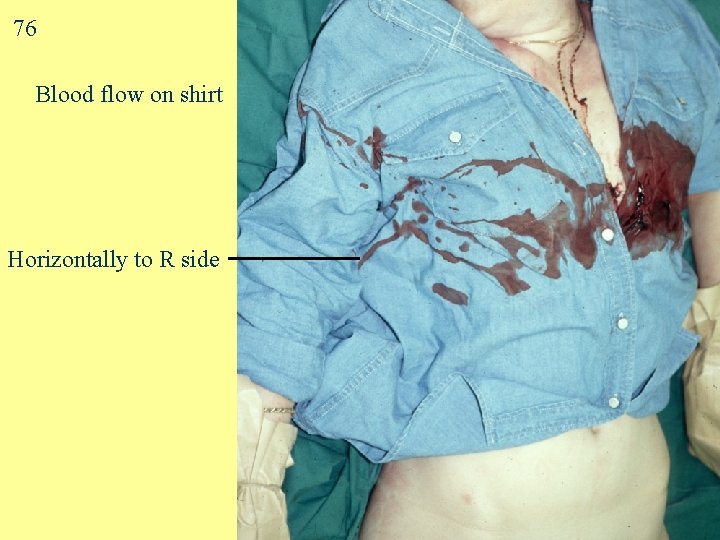 76 Blood flow on shirt Horizontally to R side 