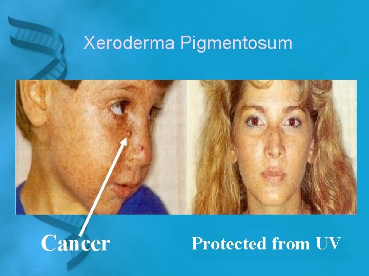 Xeroderma Pigmentosum Cancer Protected from UV 