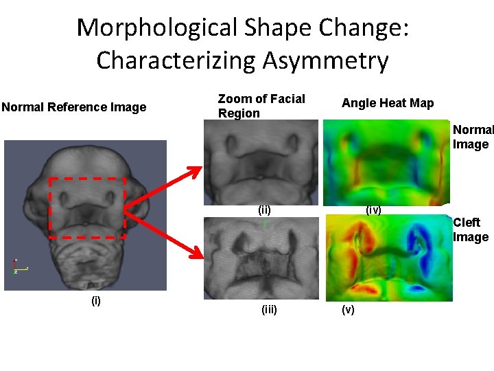 Morphological Shape Change: Characterizing Asymmetry Normal Reference Image Zoom of Facial Region Angle Heat