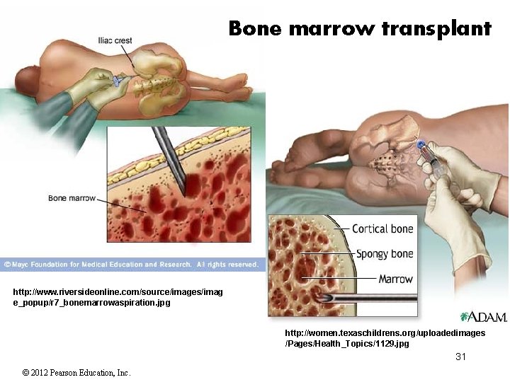 Bone marrow transplant http: //www. riversideonline. com/source/images/imag e_popup/r 7_bonemarrowaspiration. jpg http: //women. texaschildrens. org/uploadedimages