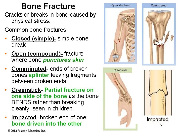 Bone Fracture Cracks or breaks in bone caused by physical stress. Common bone fractures: