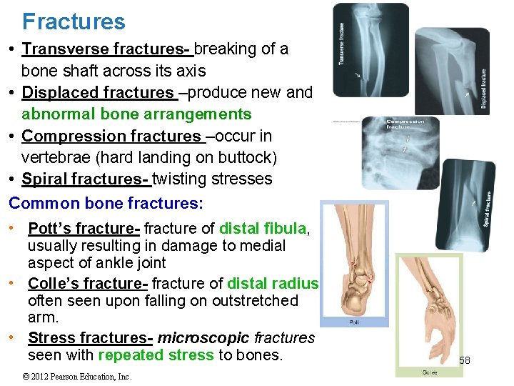 Fractures • Transverse fractures- breaking of a bone shaft across its axis • Displaced