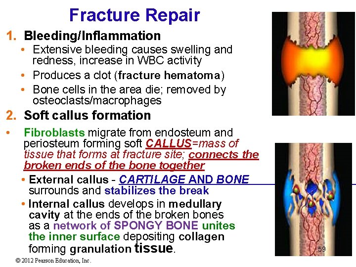 Fracture Repair 1. Bleeding/Inflammation • Extensive bleeding causes swelling and redness, increase in WBC