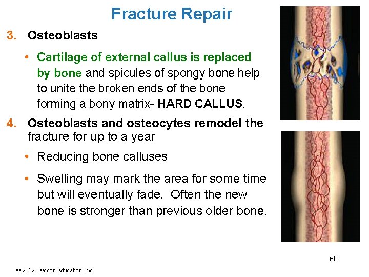 Fracture Repair 3. Osteoblasts • Cartilage of external callus is replaced by bone and