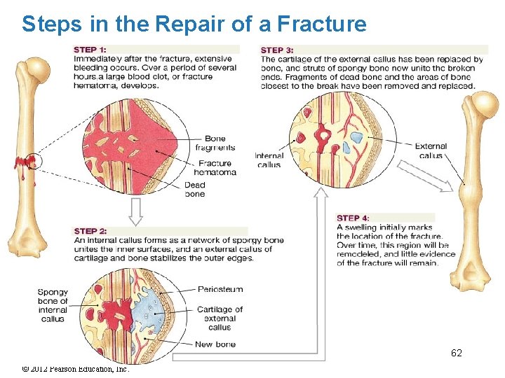 Steps in the Repair of a Fracture 62 © 2012 Pearson Education, Inc. 