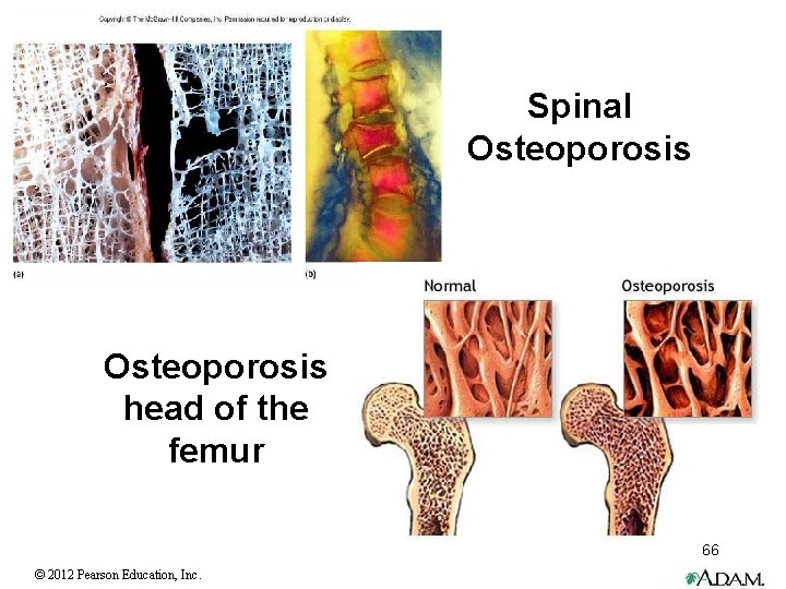 Spinal Osteoporosis head of the femur 66 © 2012 Pearson Education, Inc. 