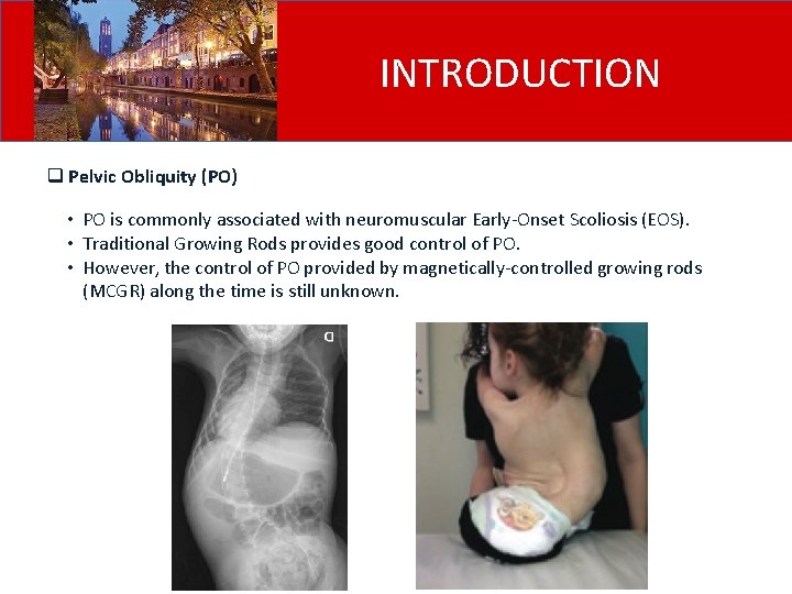 INTRODUCTION q Pelvic Obliquity (PO) • PO is commonly associated with neuromuscular Early-Onset Scoliosis