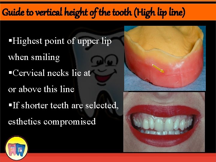 Guide to vertical height of the tooth (High lip line) §Highest point of upper